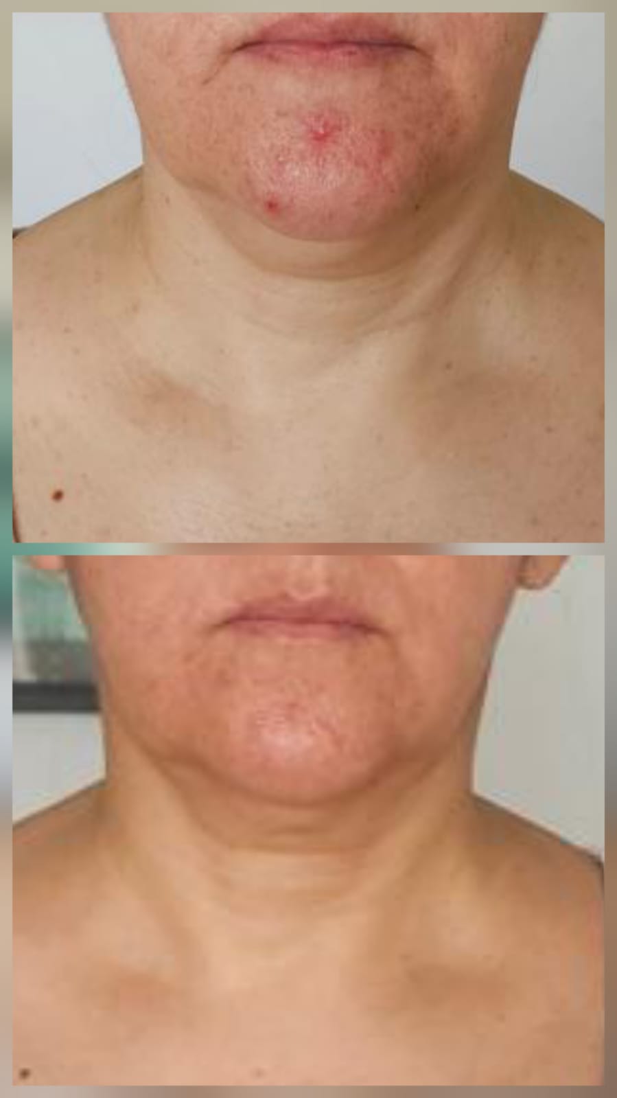 NatFacelift Before and After Result 1