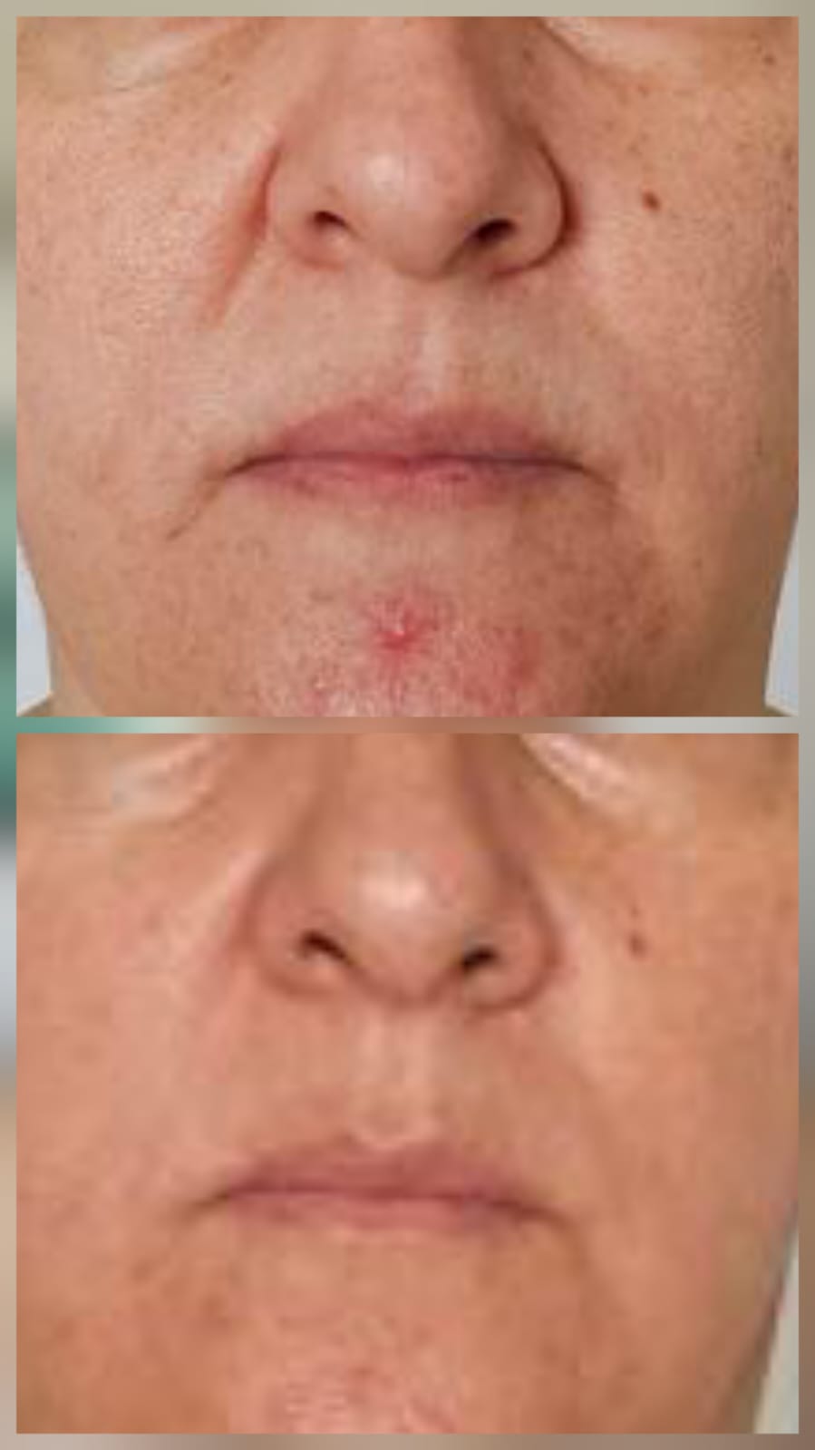 NatFacelift Before and After Result 2