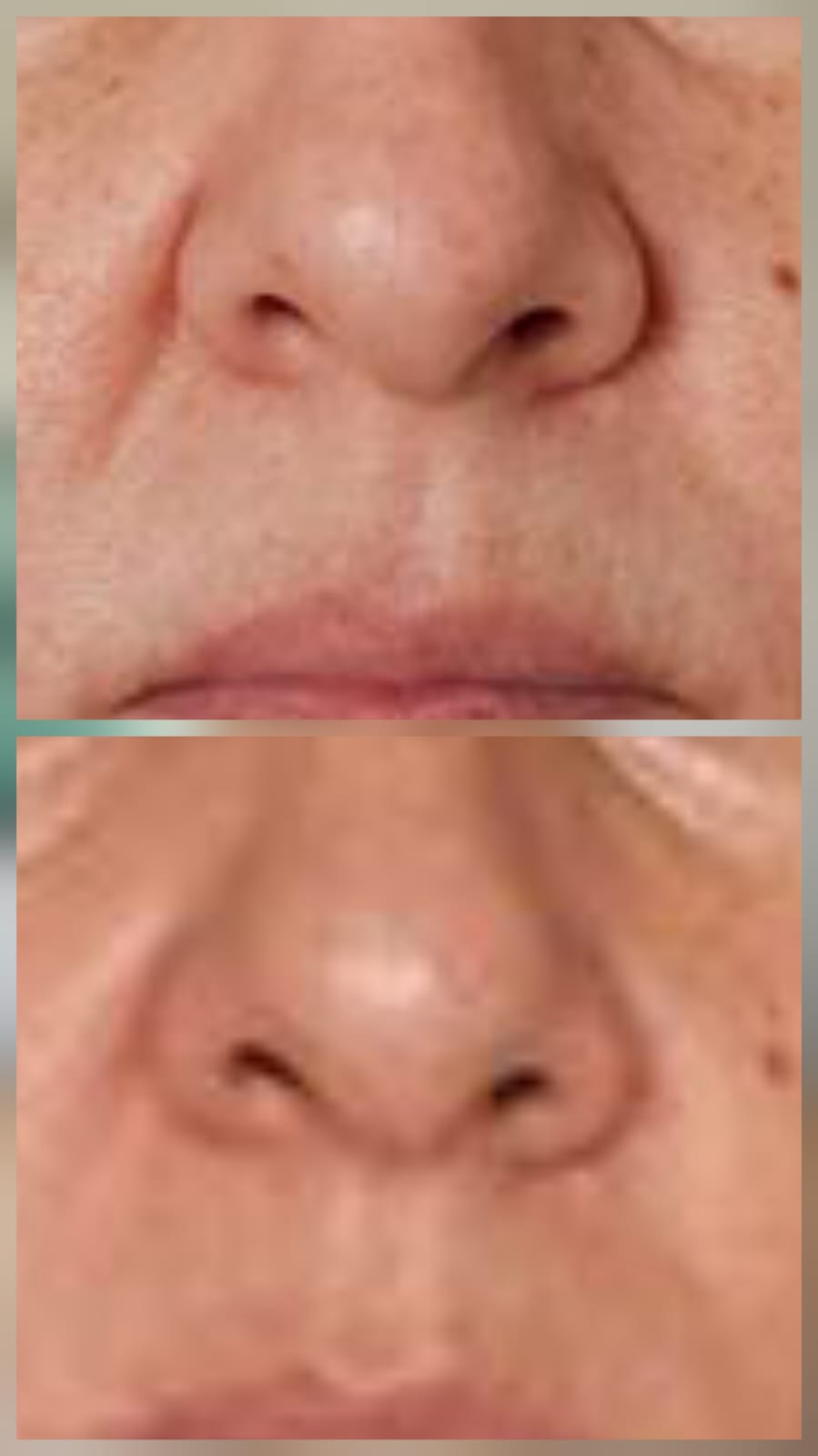 NatFacelift Before and After Result 3